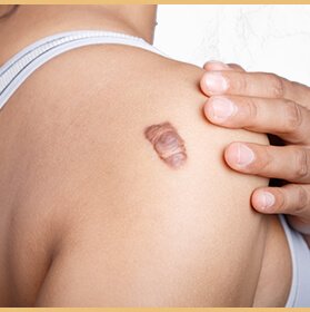 katlin-pizzo-cirurgia-reparadora-queloides-thumb